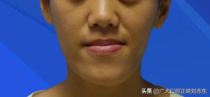 导致大小脸最关键的原因,造成大小脸的原因和矫正方法