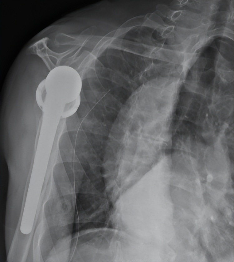 陈旧性肩关节脱臼有必要做手术吗,多年陈旧性肘关节脱臼