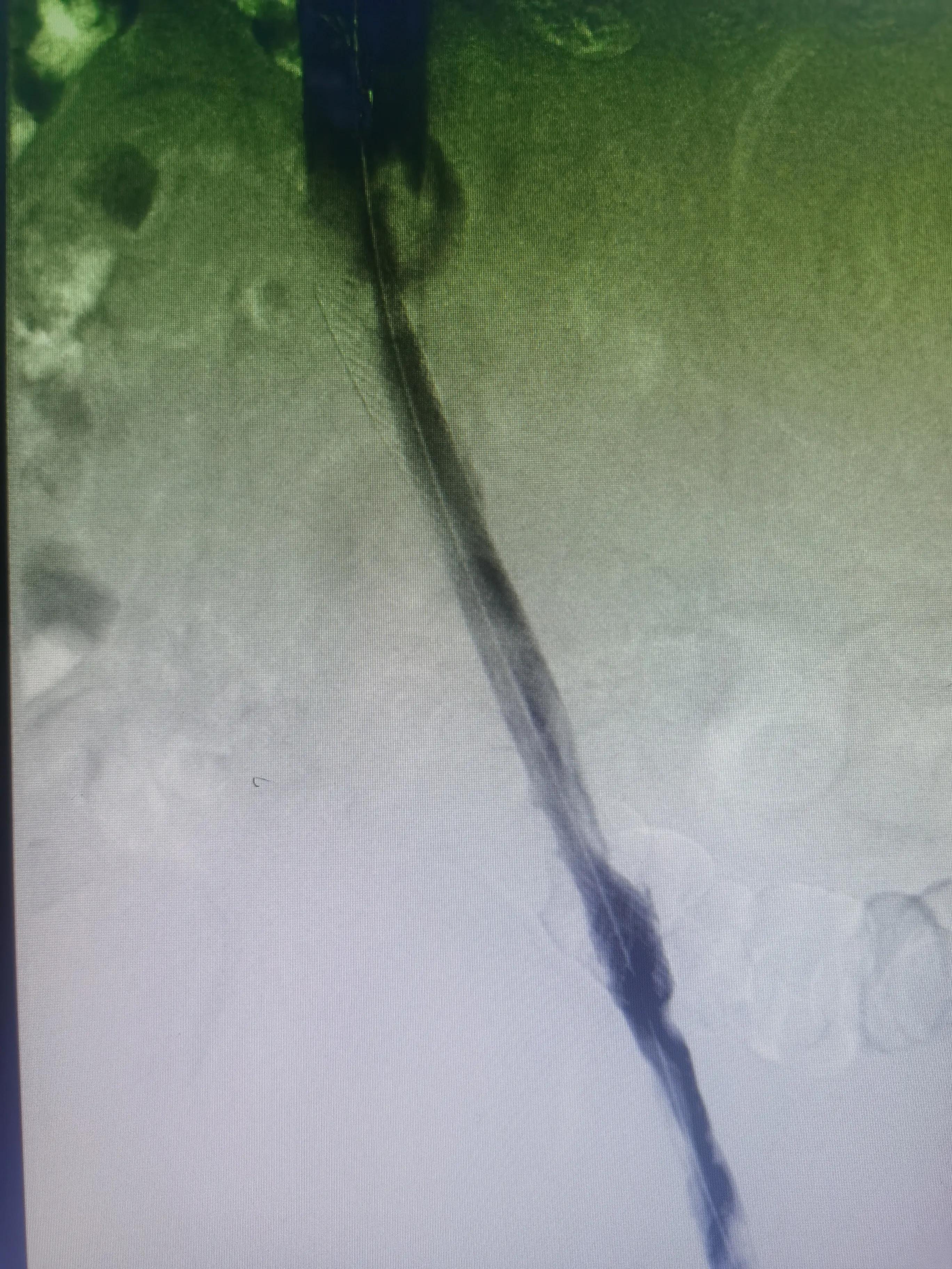 一到下午就腿肿什么原因怎么治疗,腿肿是什么病的前兆怎么治疗