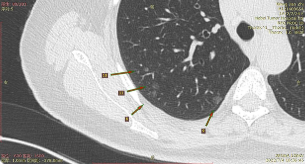 首次发现磨玻璃结节要吃药消炎吗,磨玻璃结节警惕合并占位