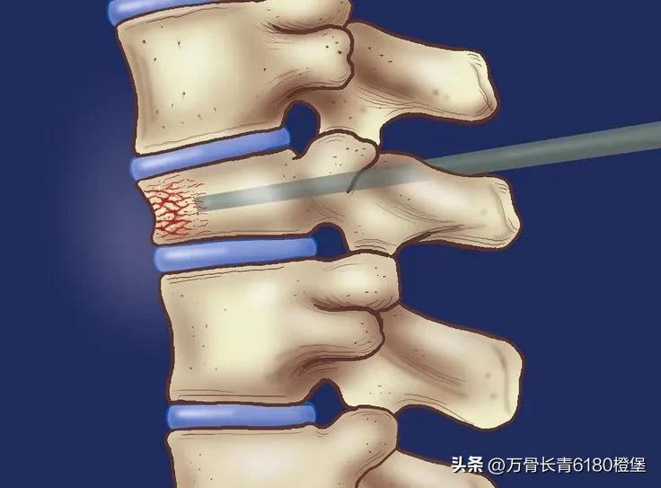 骨质疏松性椎体压缩骨折多久能好,骨质疏松性椎体压缩骨折修复效果