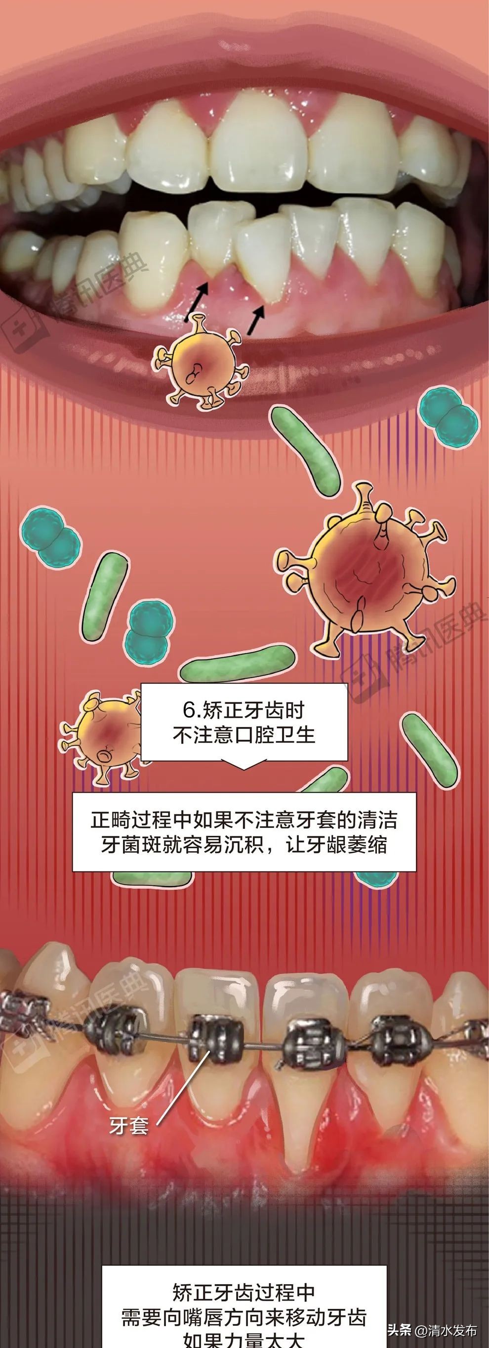 两边大牙一吃肉就塞牙如何修复,14岁学生吃肉老是塞牙需要矫正吗