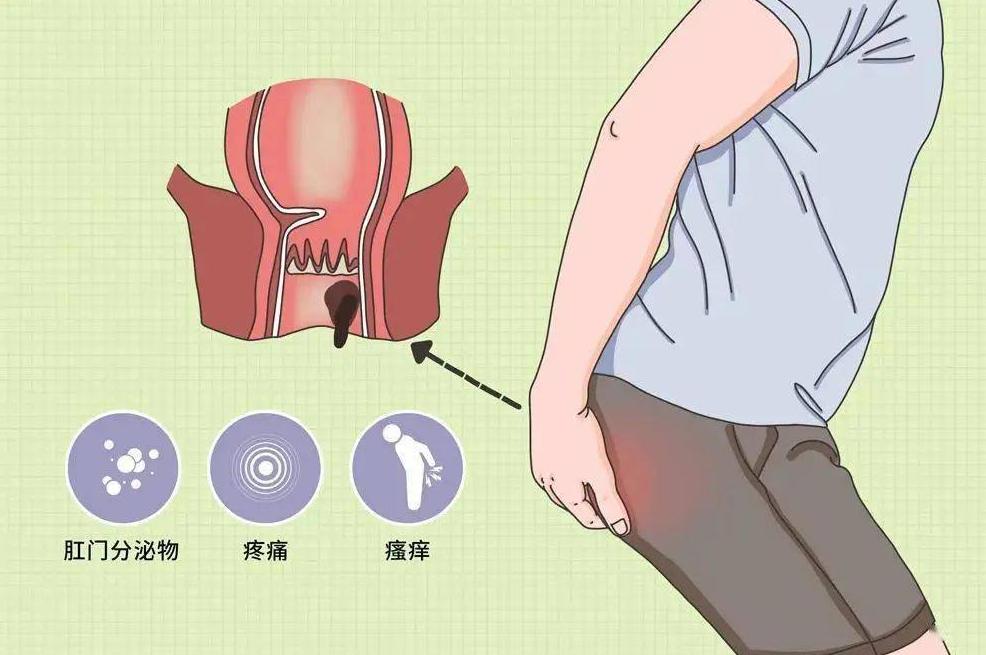 肛裂之后是不是很容易继续肛裂,如果是肛裂该怎么处理