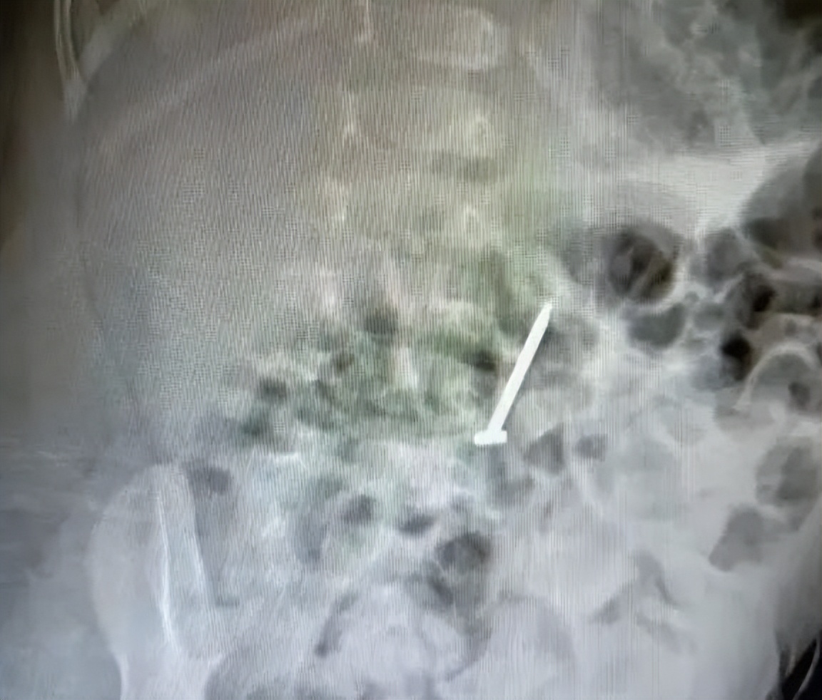 11个月大婴儿,吞下一枚3cm钉子!家长平时一定要收好家中小物品