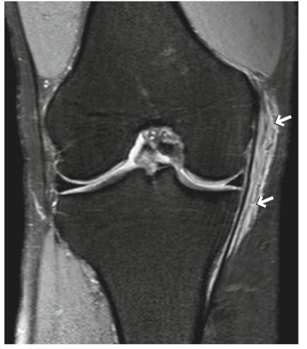 mcl内侧副韧带,内侧副韧带部分撕裂稳定性