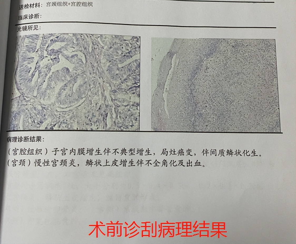 绝经后子宫内膜6mm癌的几率是多少,绝经后流血一定会是子宫内膜癌吗