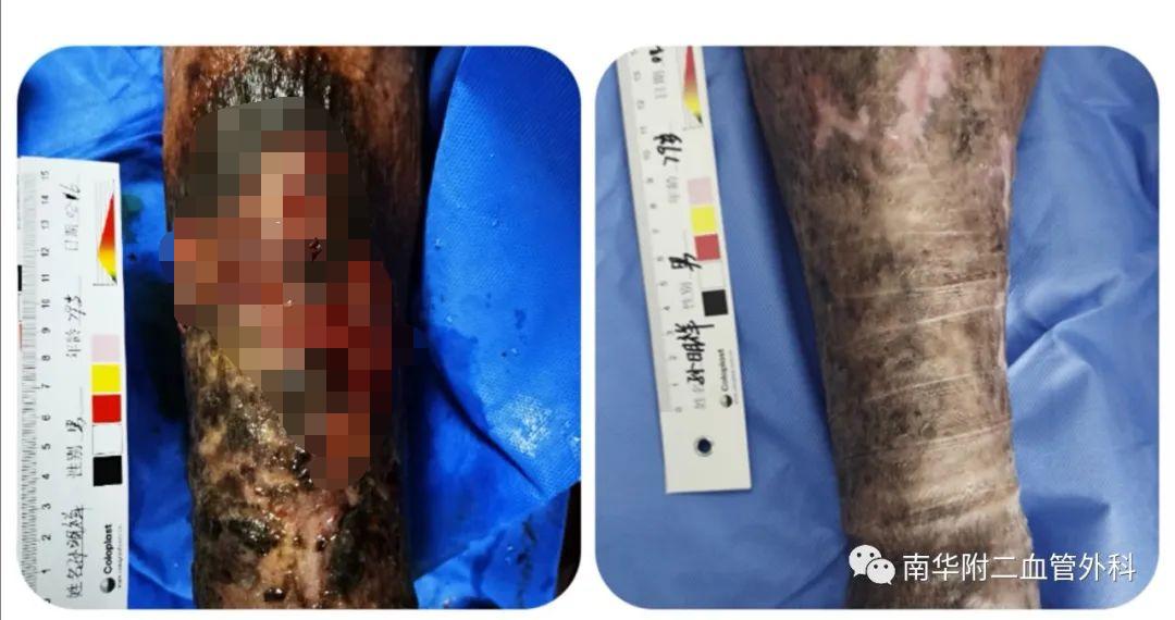 慢性创面治疗中心,创面治疗门诊