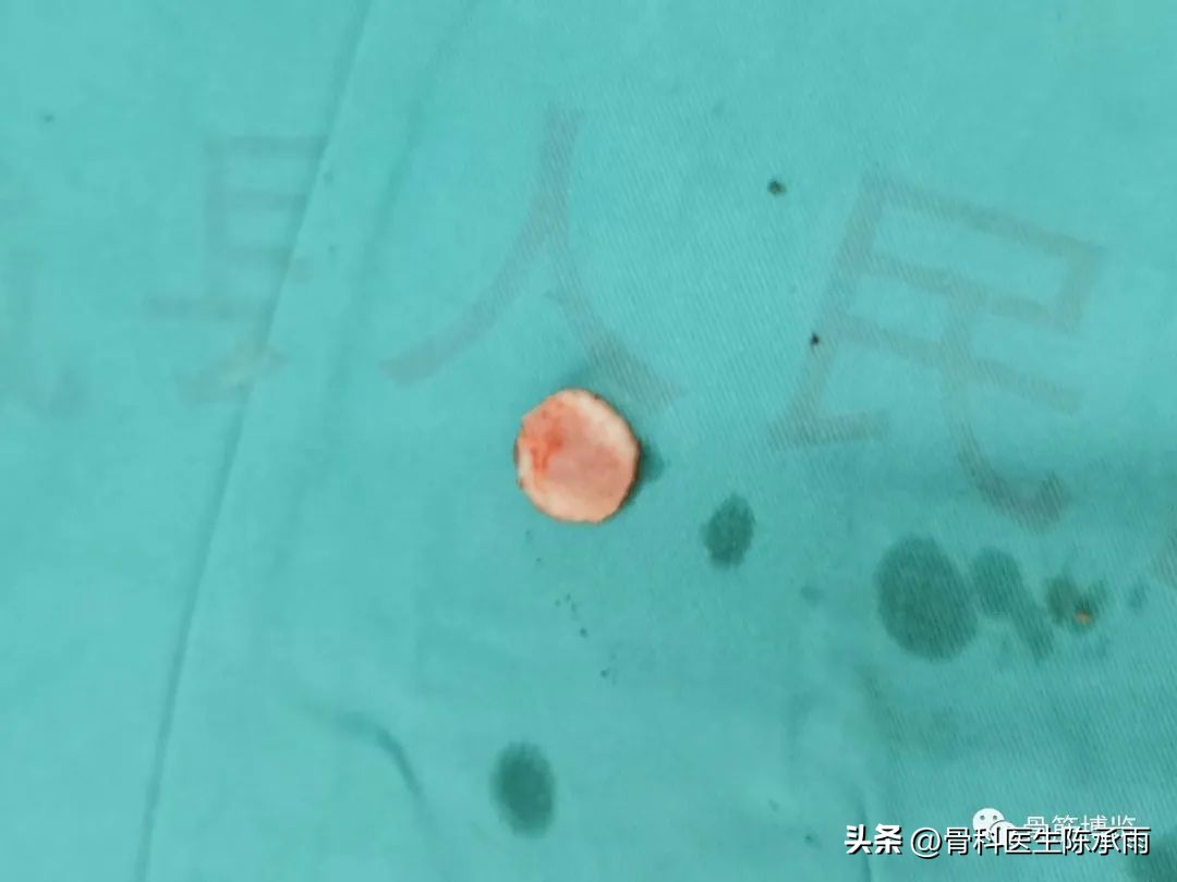 髌骨脱位软骨剥离怎么治疗,半月板撕裂游离体