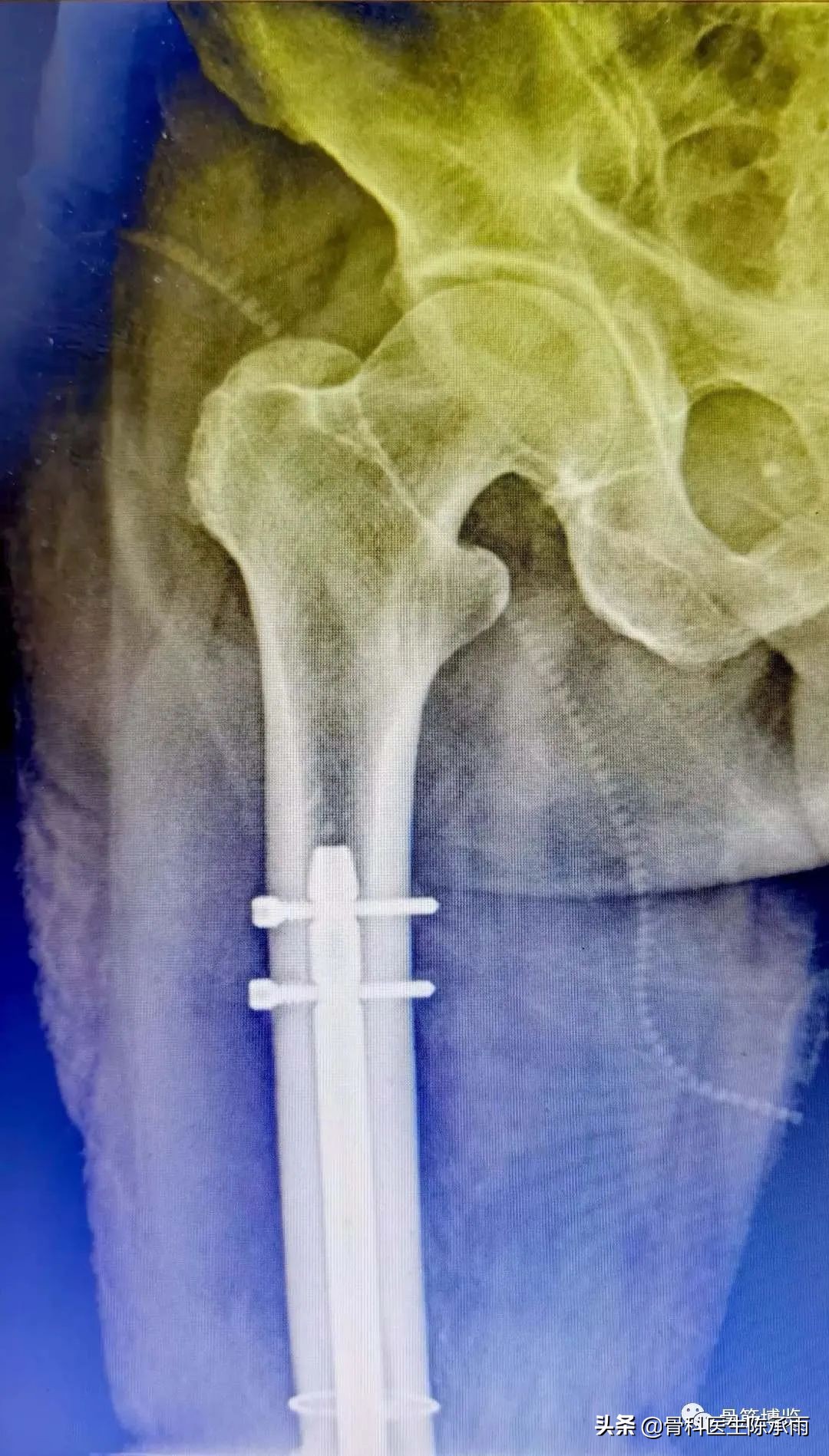 陈旧性腿骨骨折,陈旧性骨折