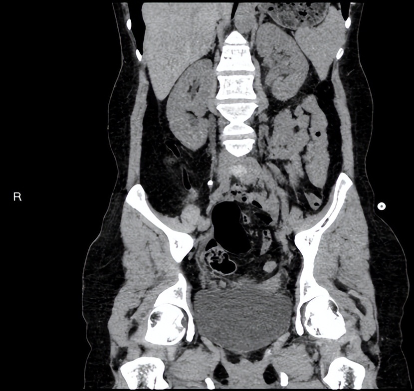 达芬奇系列|哈医大一院泌尿外科王春阳机器人团队巧用膀胱肌瓣重建输尿管助女性解除阴道漏尿困扰