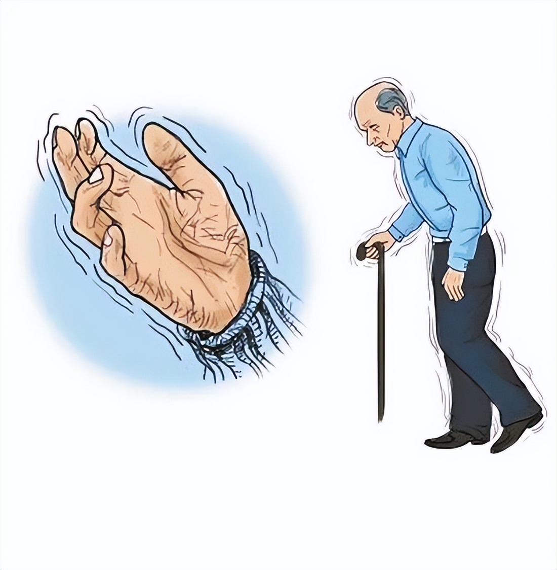 关于帕金森病您知道多少呢,关于帕金森疾病你又了解多少呢