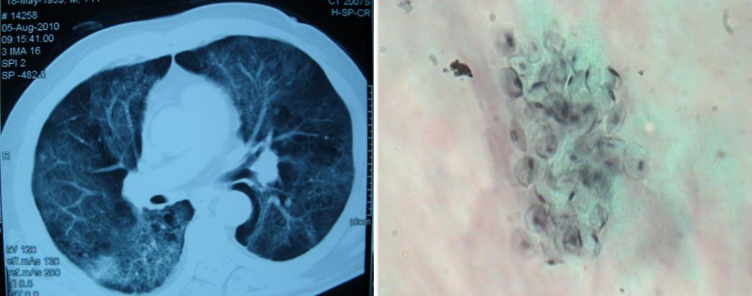 免疫缺陷病会并发什么病,什么是免疫缺陷肺部感染