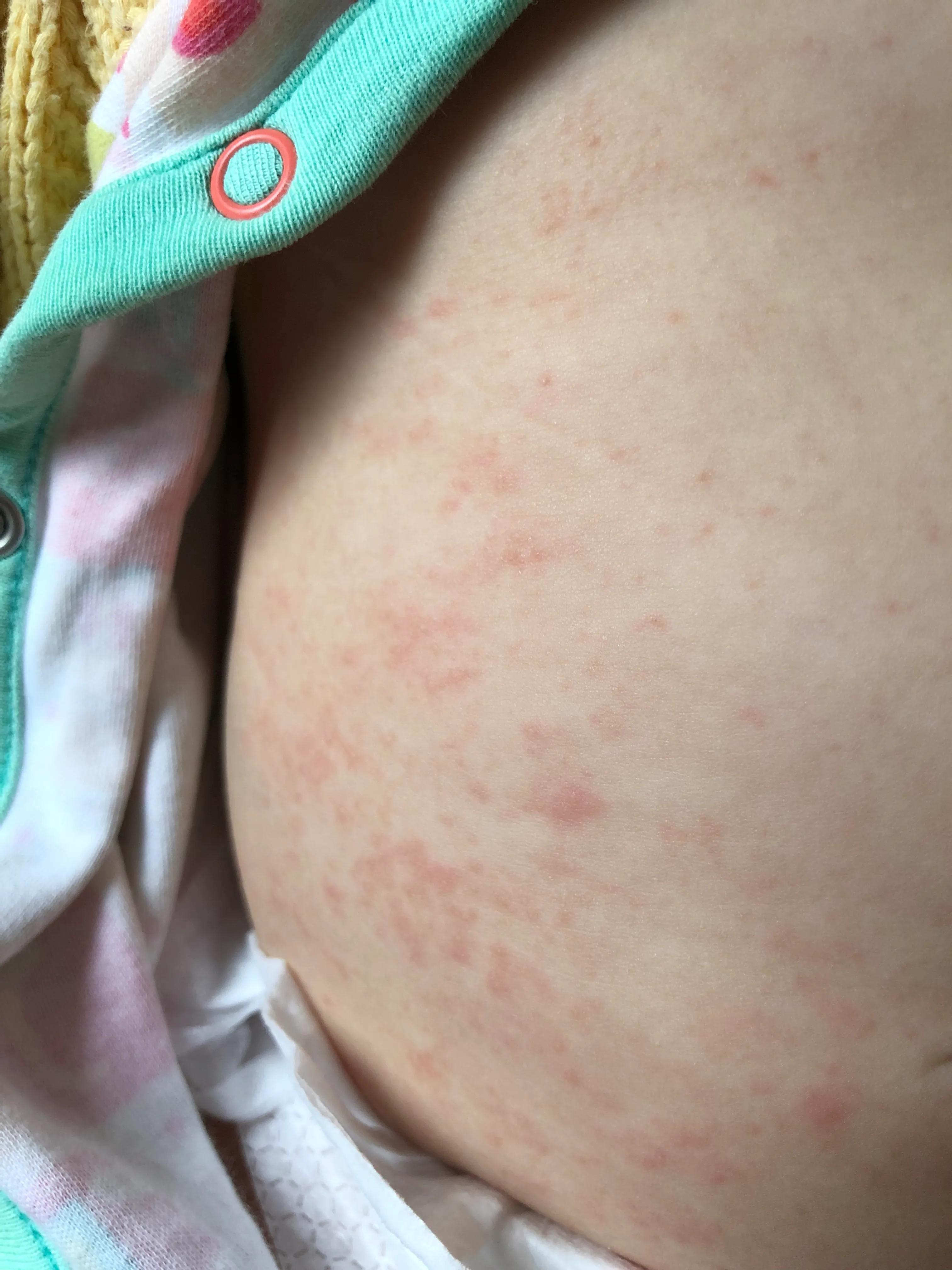 7个半月婴儿发烧怎么办,7个半月婴儿发烧如何物理降温