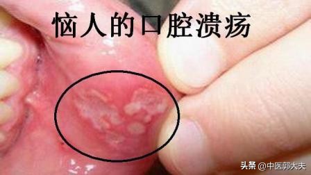 上火引起的牙疼吃甲硝唑有效吗,牙疼吃什么药牛黄甲硝唑