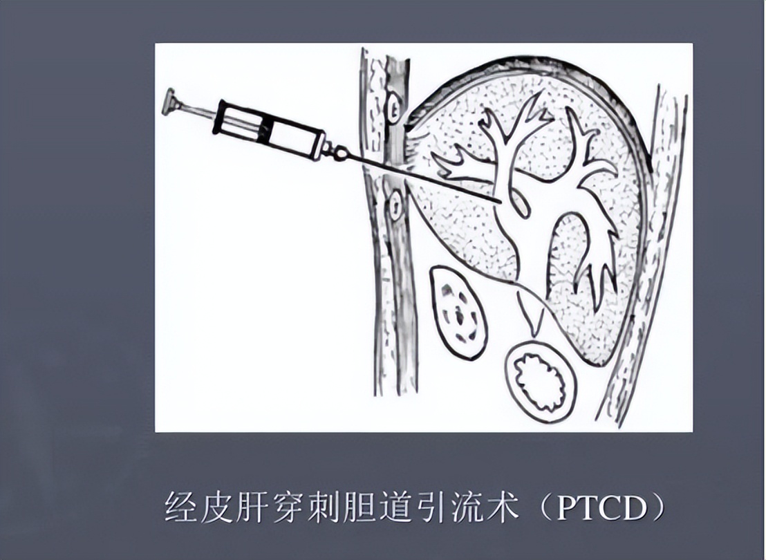 急性胆囊炎发作的原因有哪些,急性胆囊炎的症状及治疗都有哪些