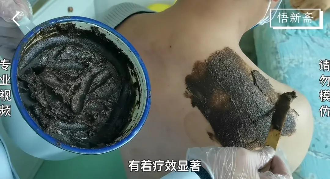 凡士林做基质新型膏药制作方法,凡士林制作中药膏药视频