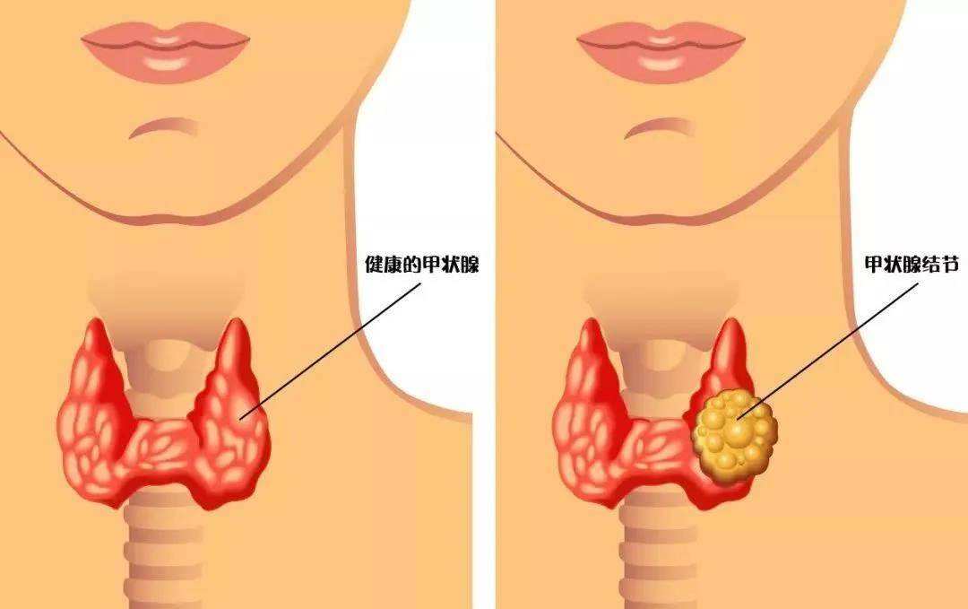 仅含3味中药，就能散尽各种结节、囊肿、肌瘤！效果很好，请收藏