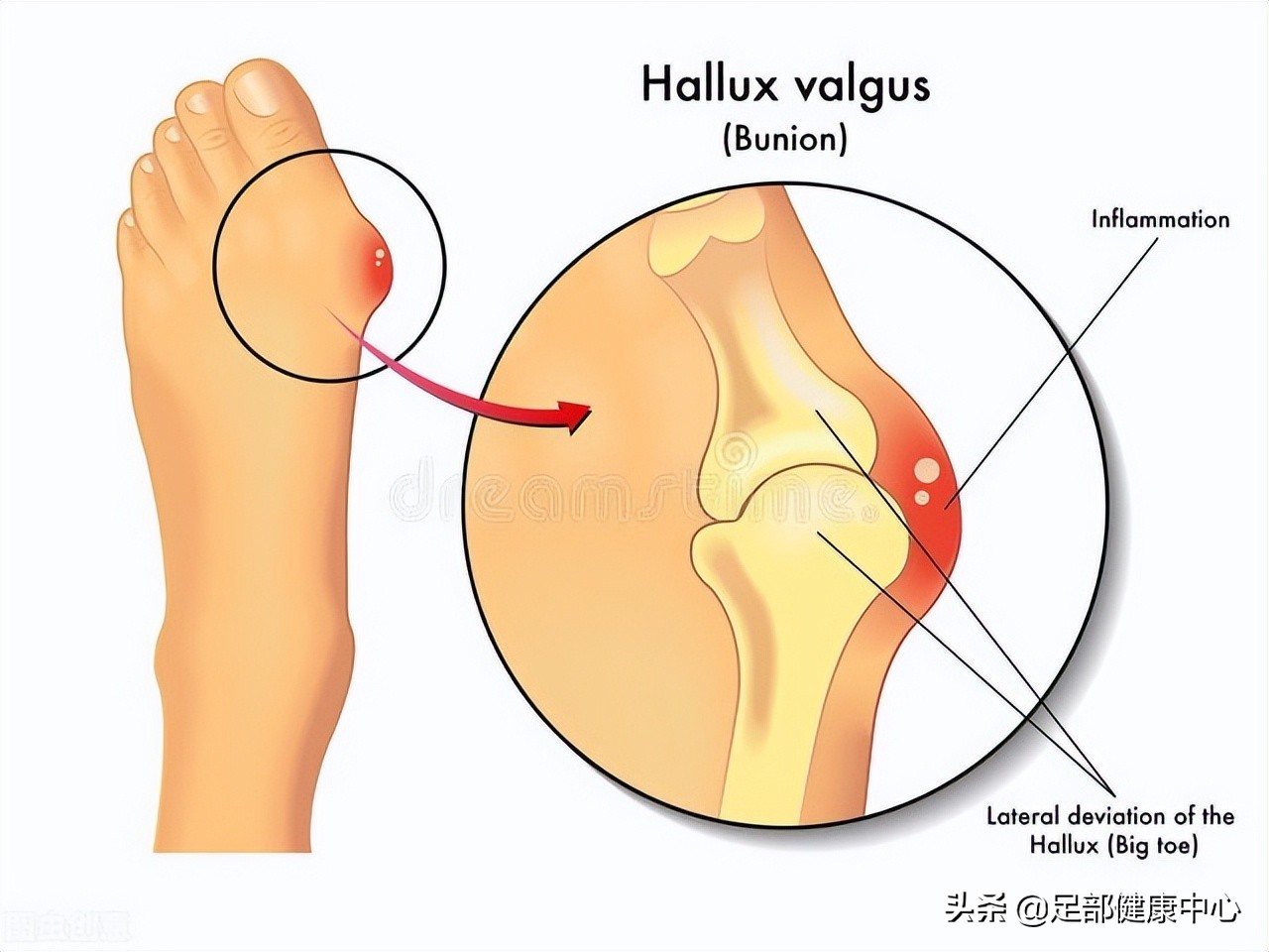 拇趾又歪又肿痛！这个女性高发病你得要小心