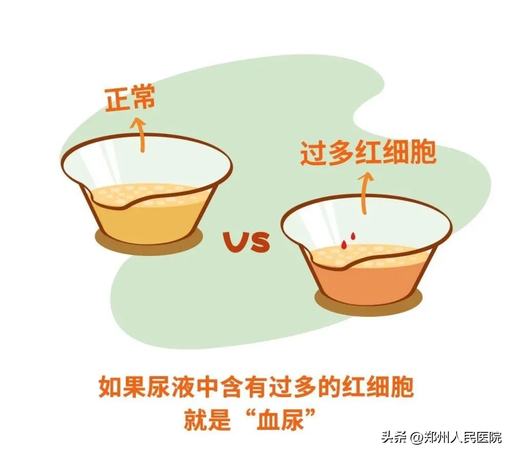 体检查出尿潜血+++,可没看见尿液里有血啊,啥情况?