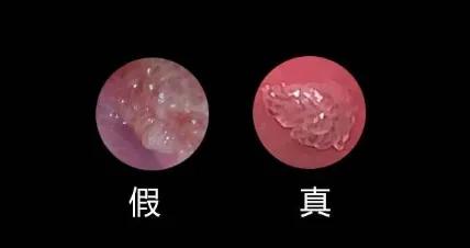尖锐性湿疣跟假性湿疣怎么区分,怎么区分尖锐性湿疣和假性湿疣