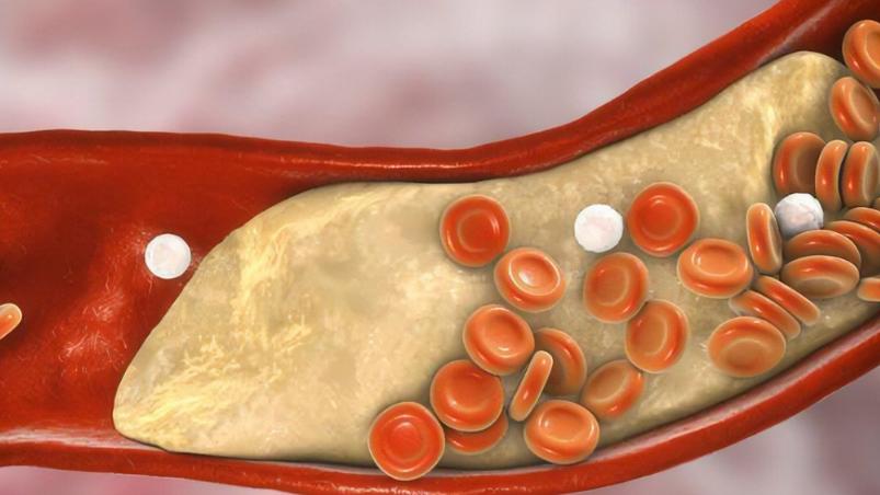 清理血管垃圾打吊瓶,清除血管垃圾输液用什么药