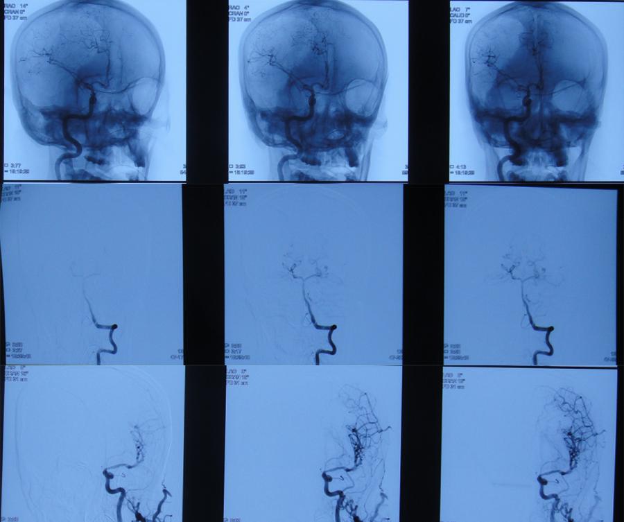 脑动脉瘤破裂手术后有脑水肿,动脉瘤开颅夹闭术出血