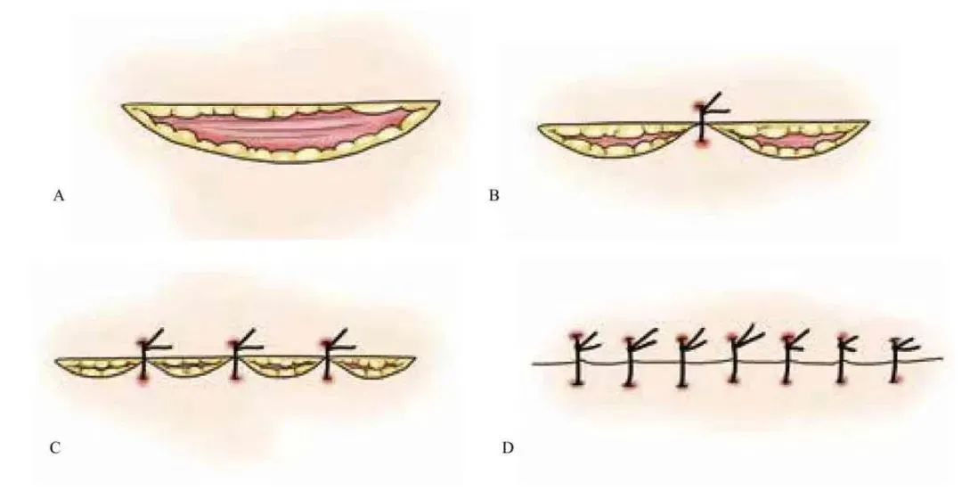 外科顶级缝针技术,外科缝合的操作细节你掌握多少