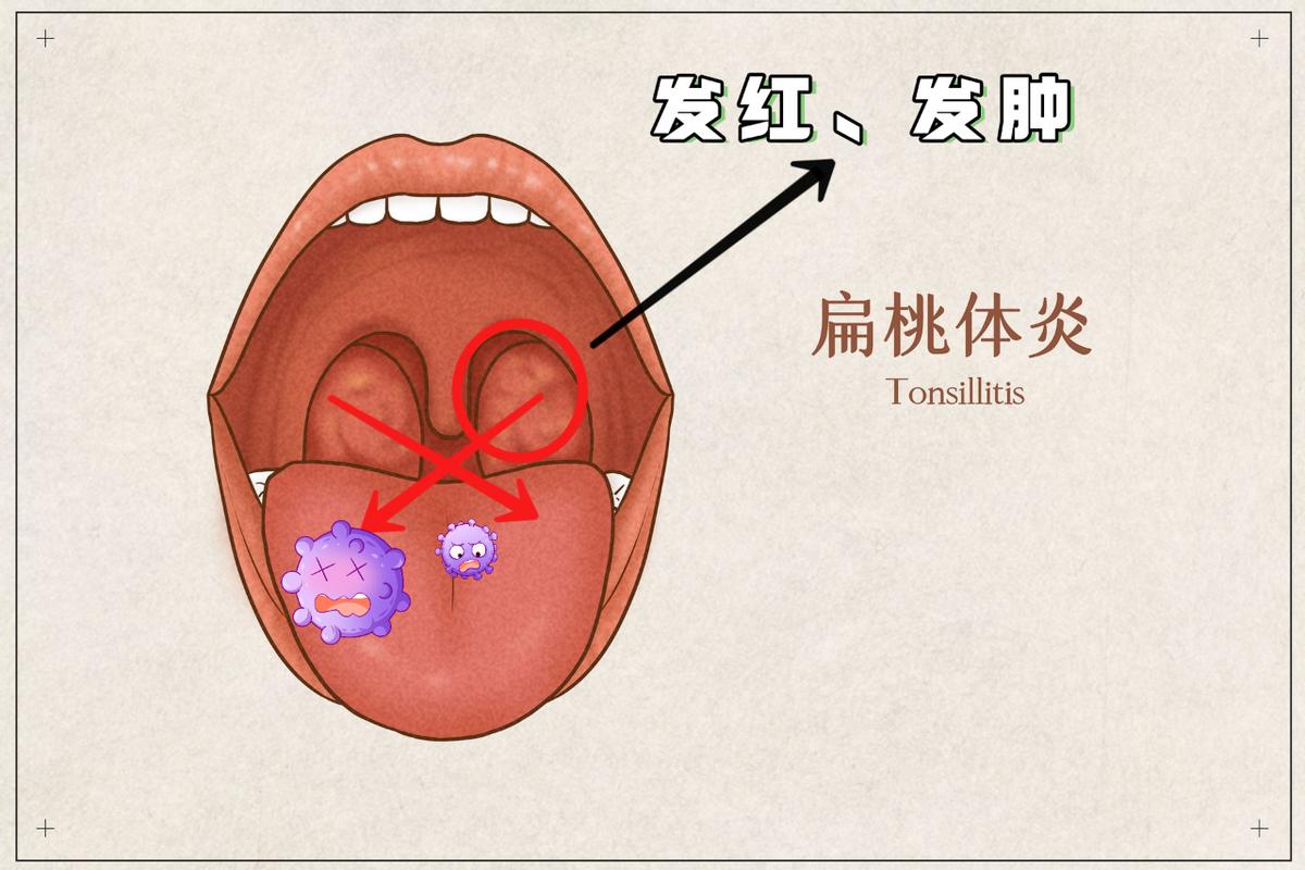 喉咙有异物感咳一下喉咙容易出血,喉咙有异物咳出水老是想咳