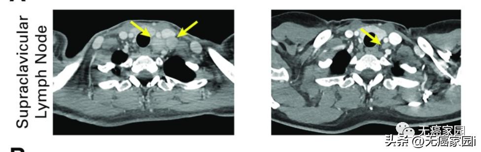 tcr-t疗法可以治疗哪些肿瘤,tcr-t细胞疗法成功率