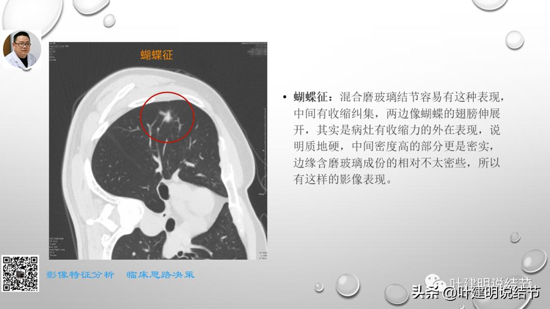 在《一脉阳光》呼吸影像诊断专题培训班上的讲课PPT（第一部分）