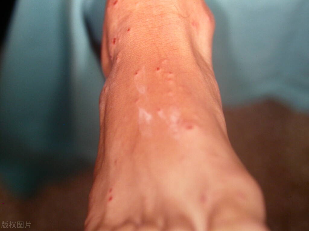 皮肤有这4种迹象当心艾滋病,早期艾滋会出现什么皮肤病