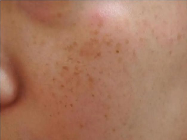 如何快速祛斑最有效的方法,祛斑最好的方法目前最有效的