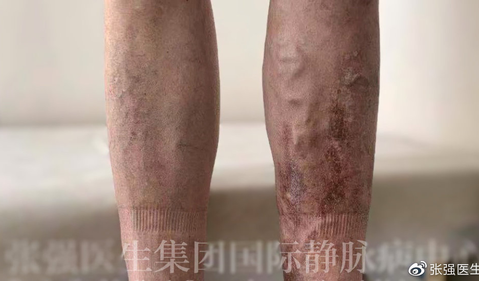 静脉曲张可以根治吗,静脉曲张能治好吗