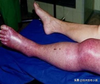 肾水肿的症状和治疗方法,诊断学水肿讲解