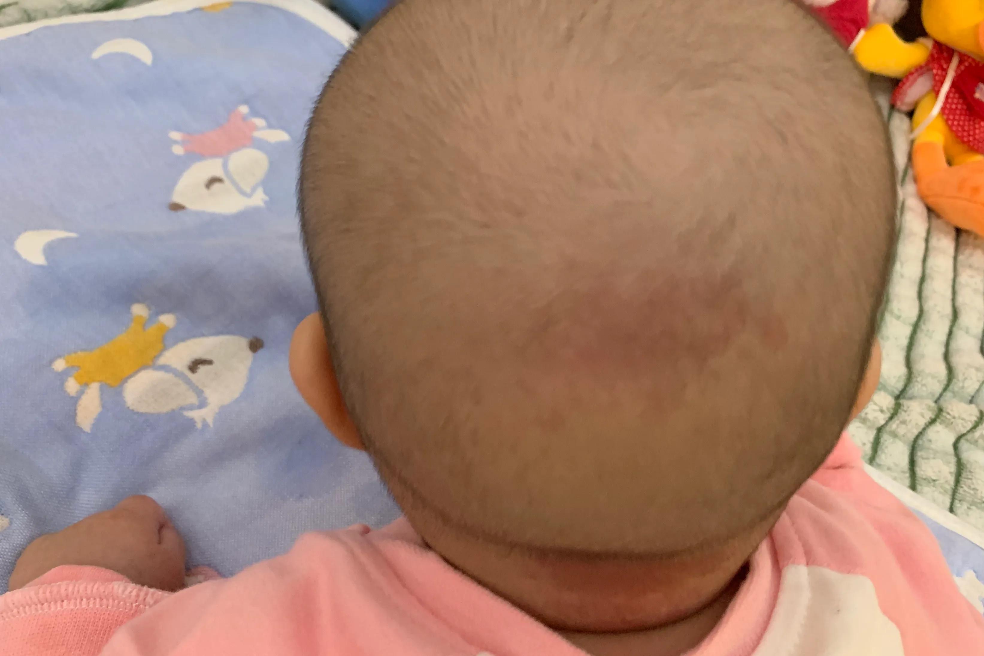 我家宝宝手上有胎记,宝宝身上有个胎记模糊不清