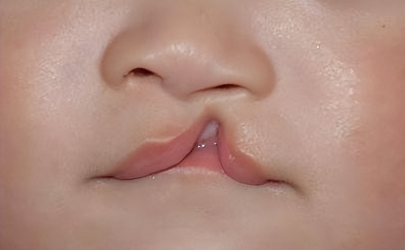 婴儿唇腭裂怎么护理,唇腭裂麻醉