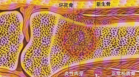 化脓性骨髓炎感染途径,化脓性骨髓炎确诊依据