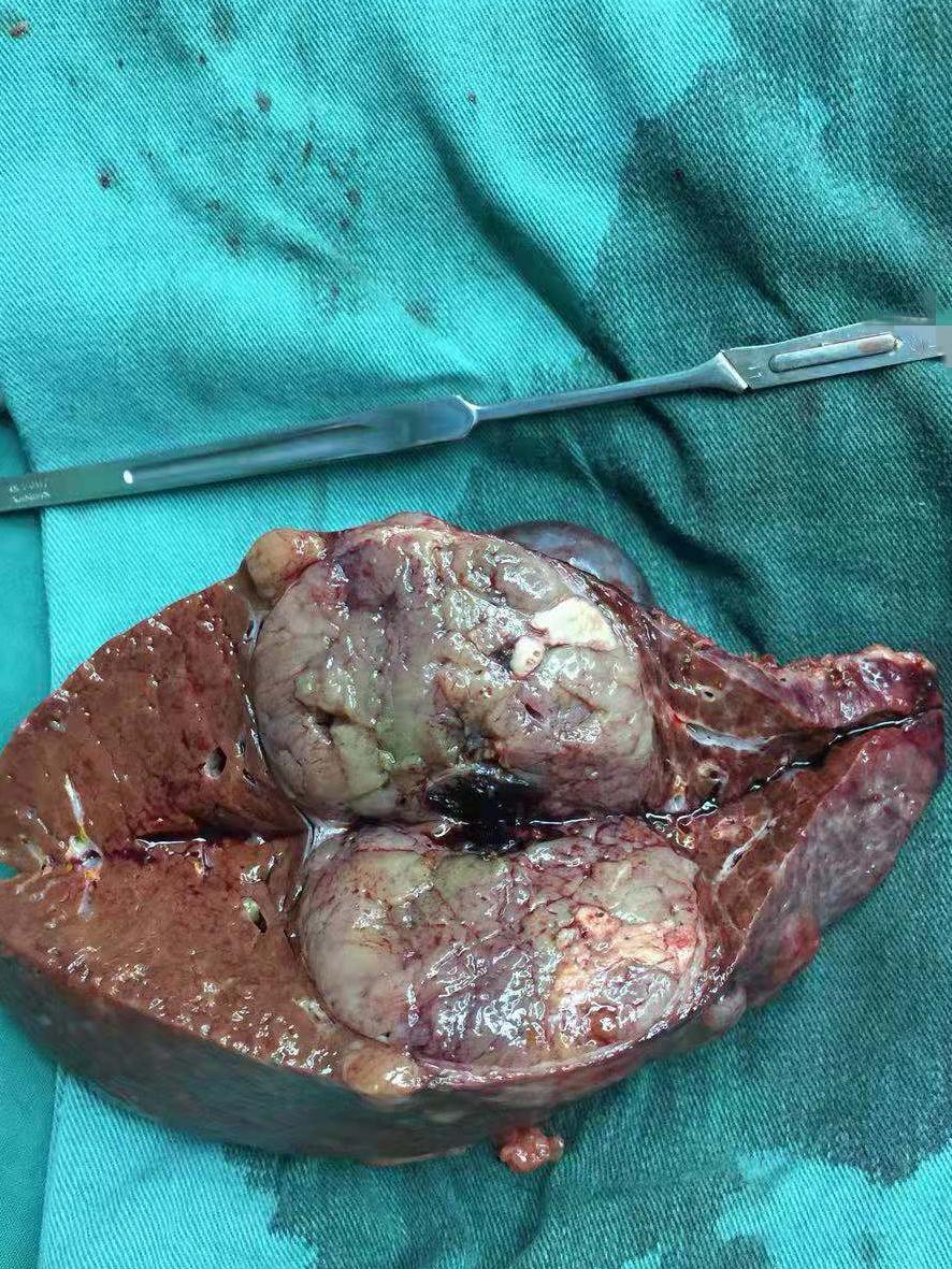 肝脏硬度值5.1kpa严重吗,肝脏硬度16.5怎么恢复