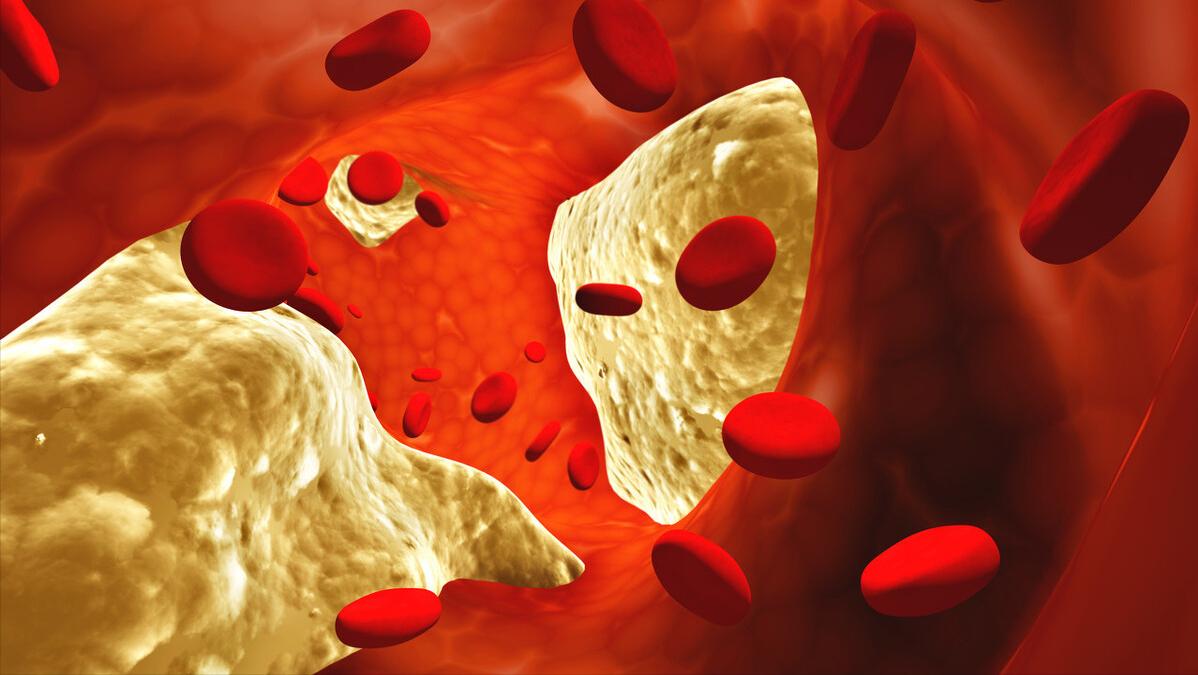 心脏支架手术做了还会堵,还有必要做吗?做与不做取决于这一点