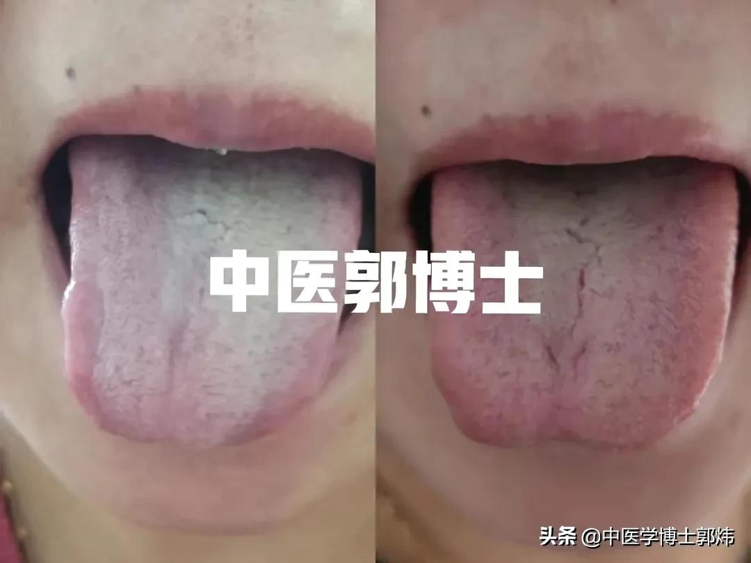 缓解胃反酸的中成药,胃反酸吃什么止酸剂
