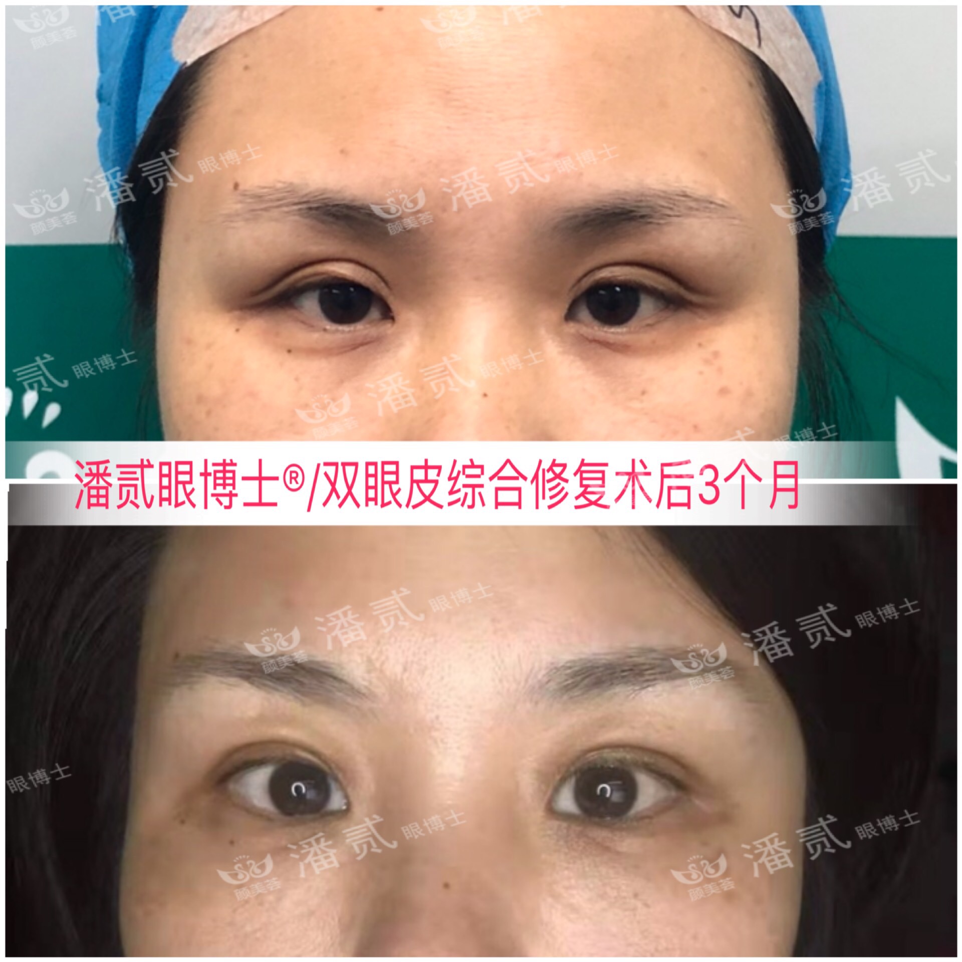 东莞整形做双眼皮,东莞整形医院割双眼皮