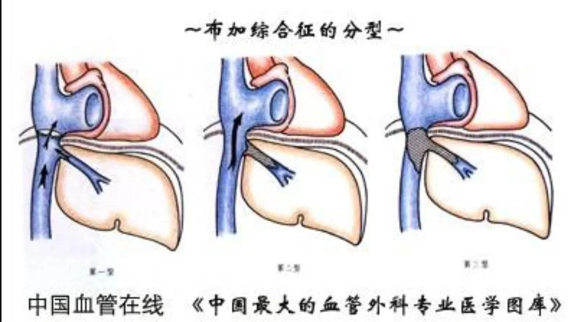 双下肢水肿心源性,心衰双下肢水肿
