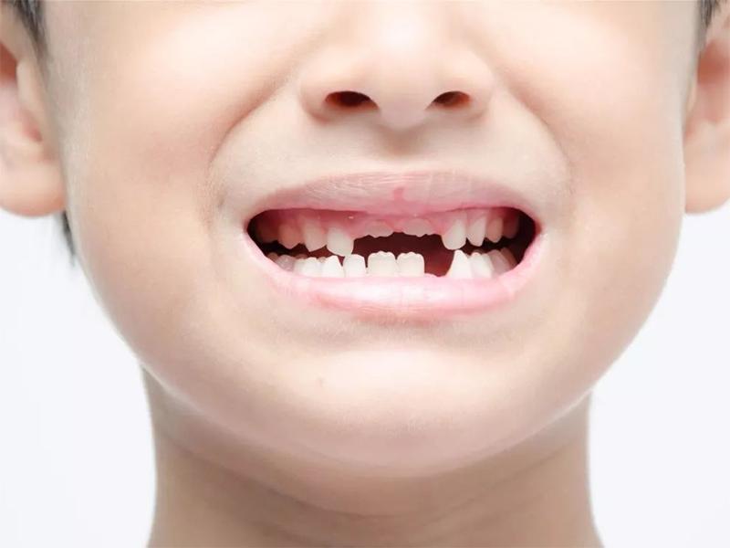 儿童何时开始换牙，应怎样做才能换出一口好牙？