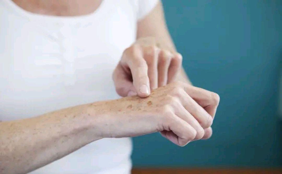 红霉素软膏能治老年斑吗,老人皮肤痒可以用红霉素软膏吗