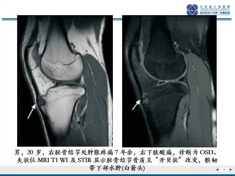 胫骨结节软骨炎要怎么治疗,胫骨结节骨软骨炎会癌变吗