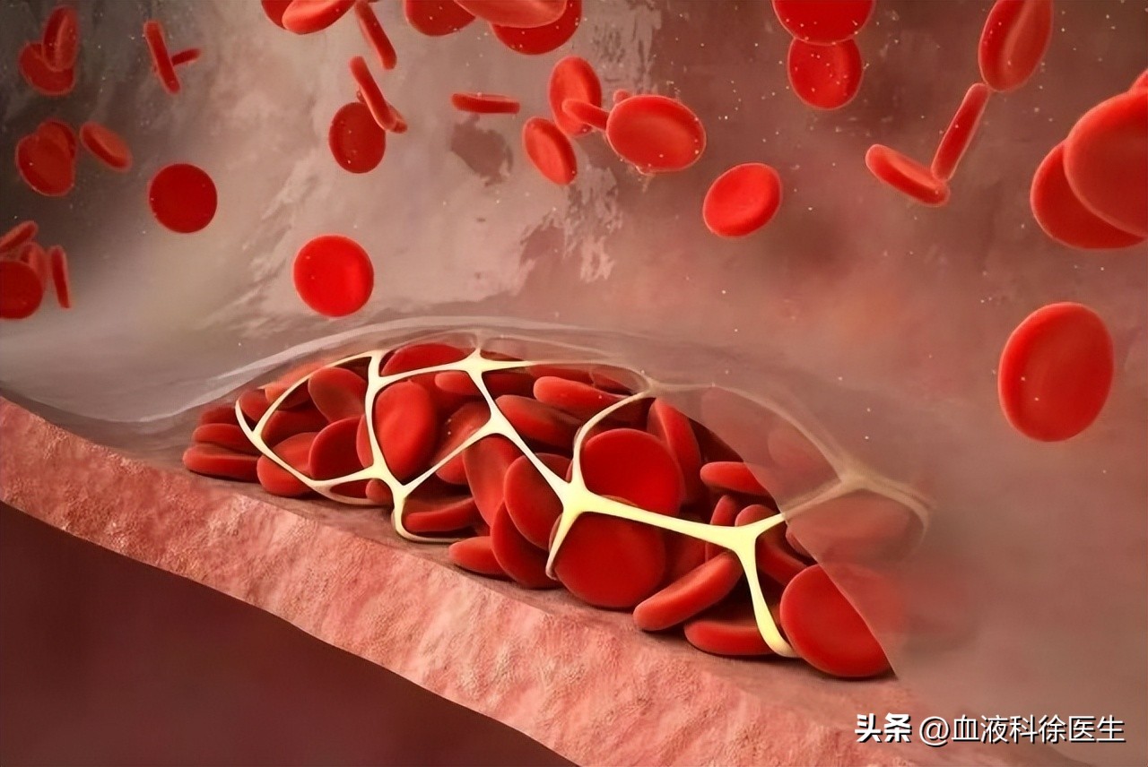 血栓来临腿部先知,血栓病手脚有什么症状