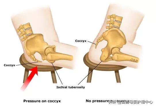 怀孕有一种痛，叫“尾骨痛”尾骨痛怎么办？