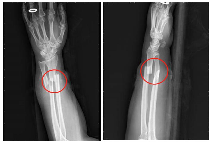 治疗骨折新技术,微创手术治疗骨折的方法
