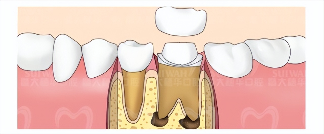 根管治疗后牙体修复,牙齿根管治疗亲身经历全过程