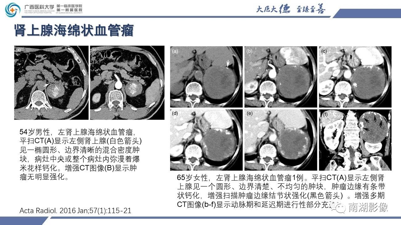 肾上腺海绵状血管瘤,肾上腺血管瘤是良性还是恶性